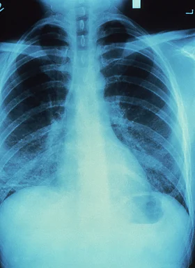 Free Stock Photo: A chest x-ray