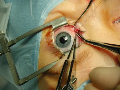 Free Stock Photo: Closeup of eye surgery